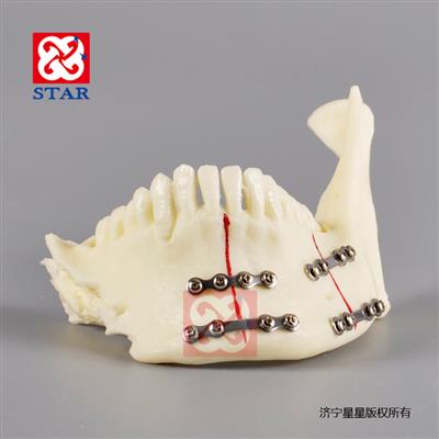 M5001常見(jiàn)骨折部位及鈦板固定