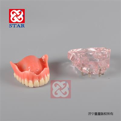 4個(gè)微型種植釘，上頜一尺修復。M6001